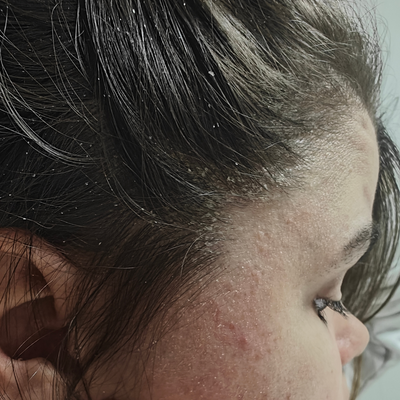 Psoriasis du cuir chevelu : comprendre et apaiser naturellement