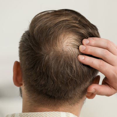 Bloqueur de DHT ou Minoxidil : quelles différences ?