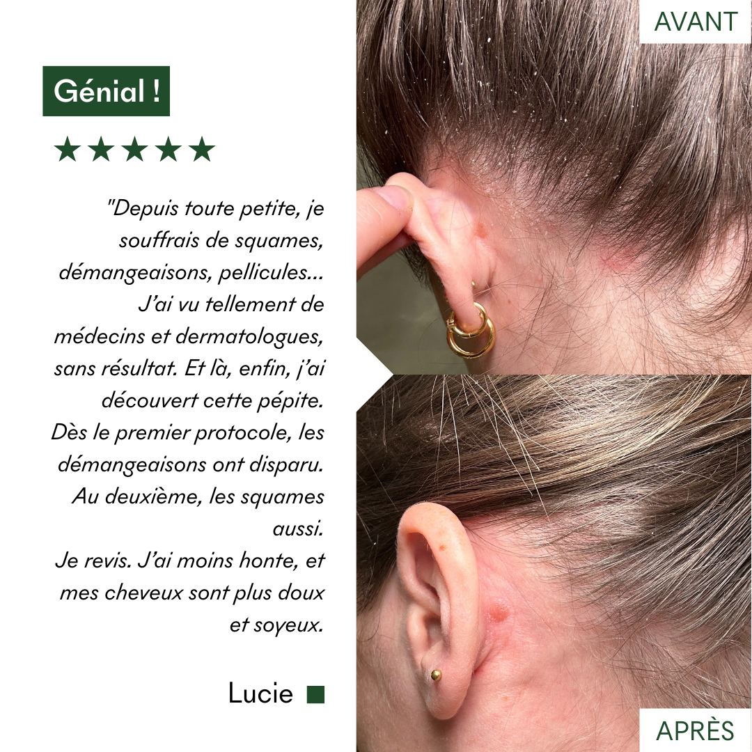 J'ai découvert ce protocole anti-pellicules grasses et dermatite séborrhéique de MakeMyMask et ça marche, voici mon avant-après
