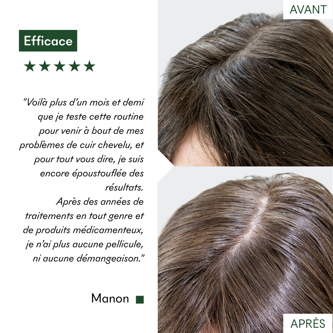 Ce protocole anti-pellicules grasses et dermatite séborrhéique de MakeMyMask est super efficace, voici mon avant-après