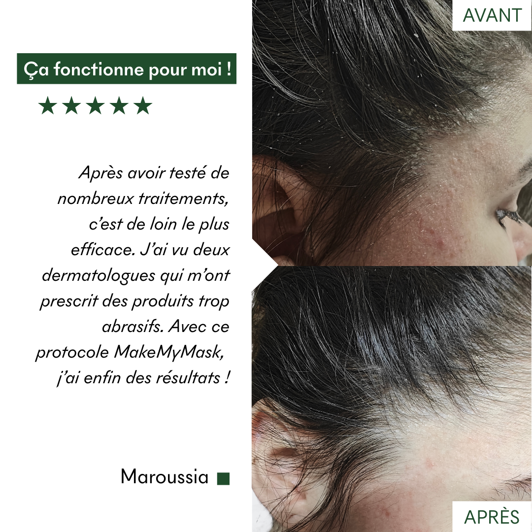 Ce protocole anti-psoriasis et plaques sèches de MakeMyMask fonctionne pour moi, voici mon avant-après