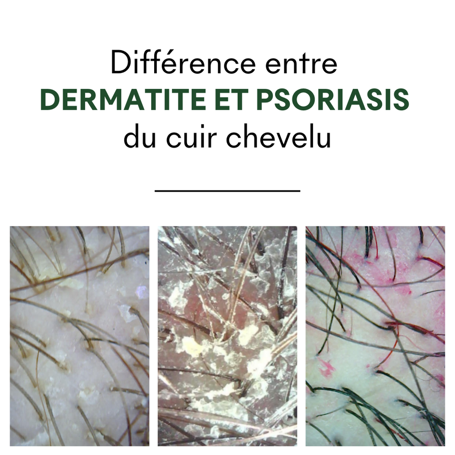concentre-anti-pso-cuir-chevelu-tricho-pure-traitement-naturel-psoriasis-squames-sans-corticoides-formule-naturelle.jpg