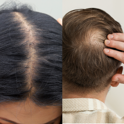 Calvitie chez l’homme VS chez la femme : quelles solutions efficaces ?