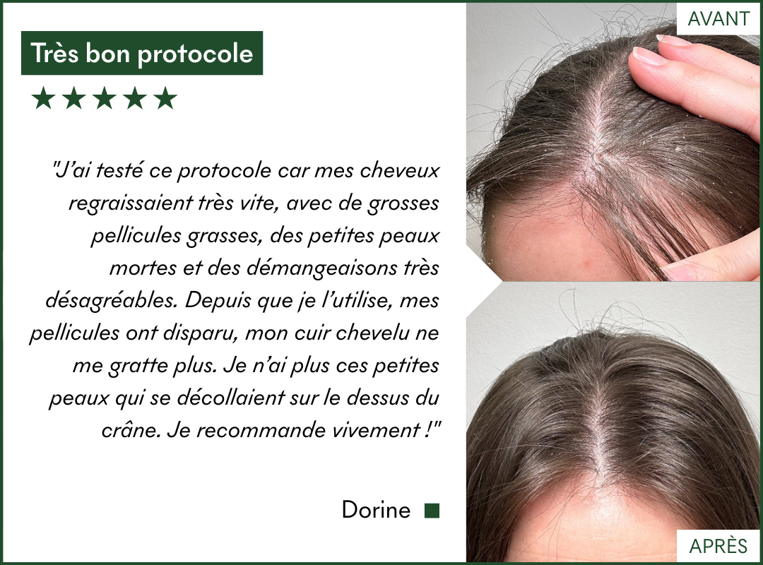 Le protocole Anti-Pellicules Grasses & DS de MakeMyMask fonctionne sur ma dermatite séborrhéique et mes pellicules, voici mon avant-après