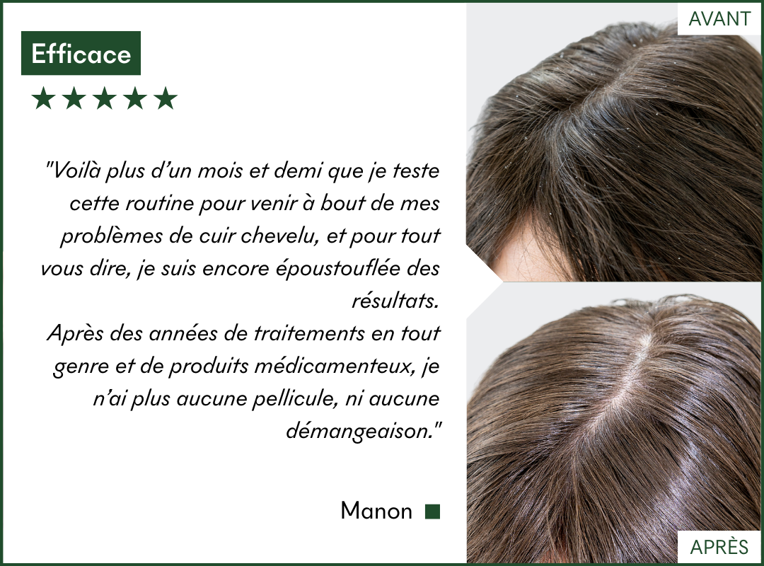 Le protocole Anti-Pellicules Grasses & DS de MakeMyMask fonctionne sur ma dermatite séborrhéique et mes pellicules, voici mon avant-après