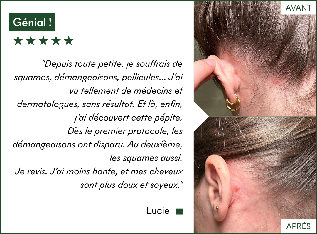 Le protocole Anti-Pellicules Grasses & DS de MakeMyMask fonctionne sur ma dermatite séborrhéique et mes pellicules, voici mon avant-après