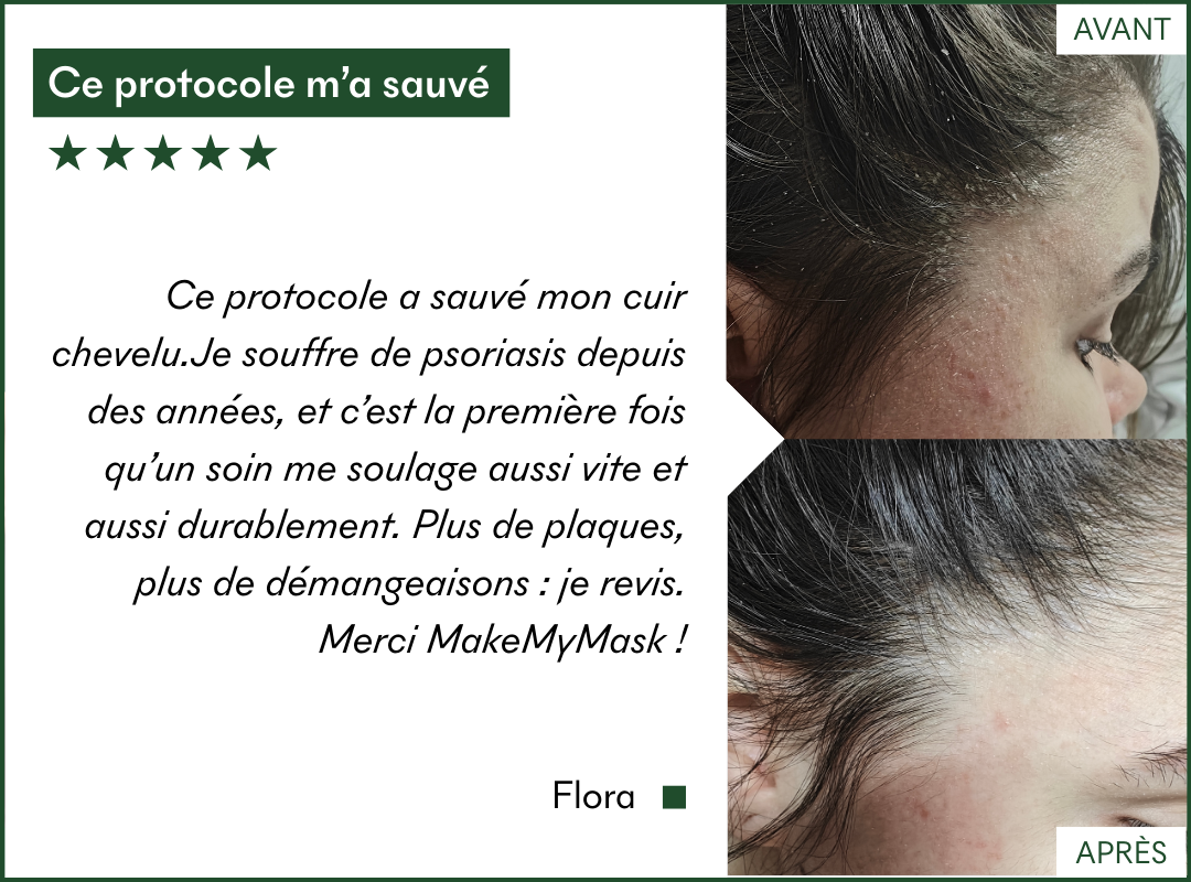 Le protocole Anti-PSO & Plaques de MakeMyMask fonctionne sur mon psoriasis et mes plaques sèches, voici mon avant-après