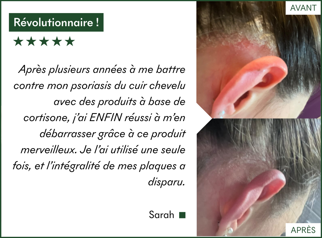 Le protocole Anti-PSO & Plaques de MakeMyMask fonctionne sur mon psoriasis et mes plaques sèches, voici mon avant-après