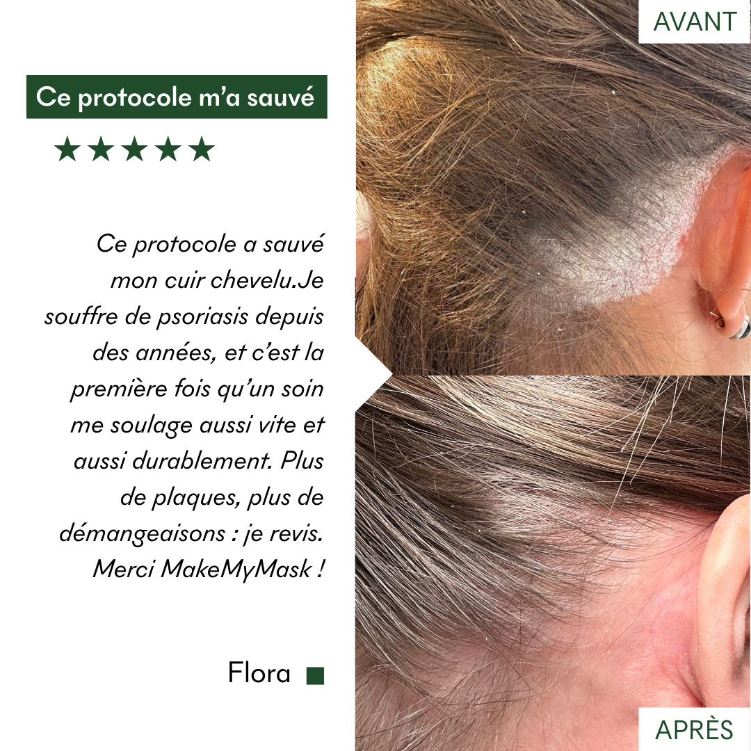 Ce protocole anti-psoriasis et plaques sèches de MakeMyMask a sauvé mon cuir chevelu, voici mon avant-après