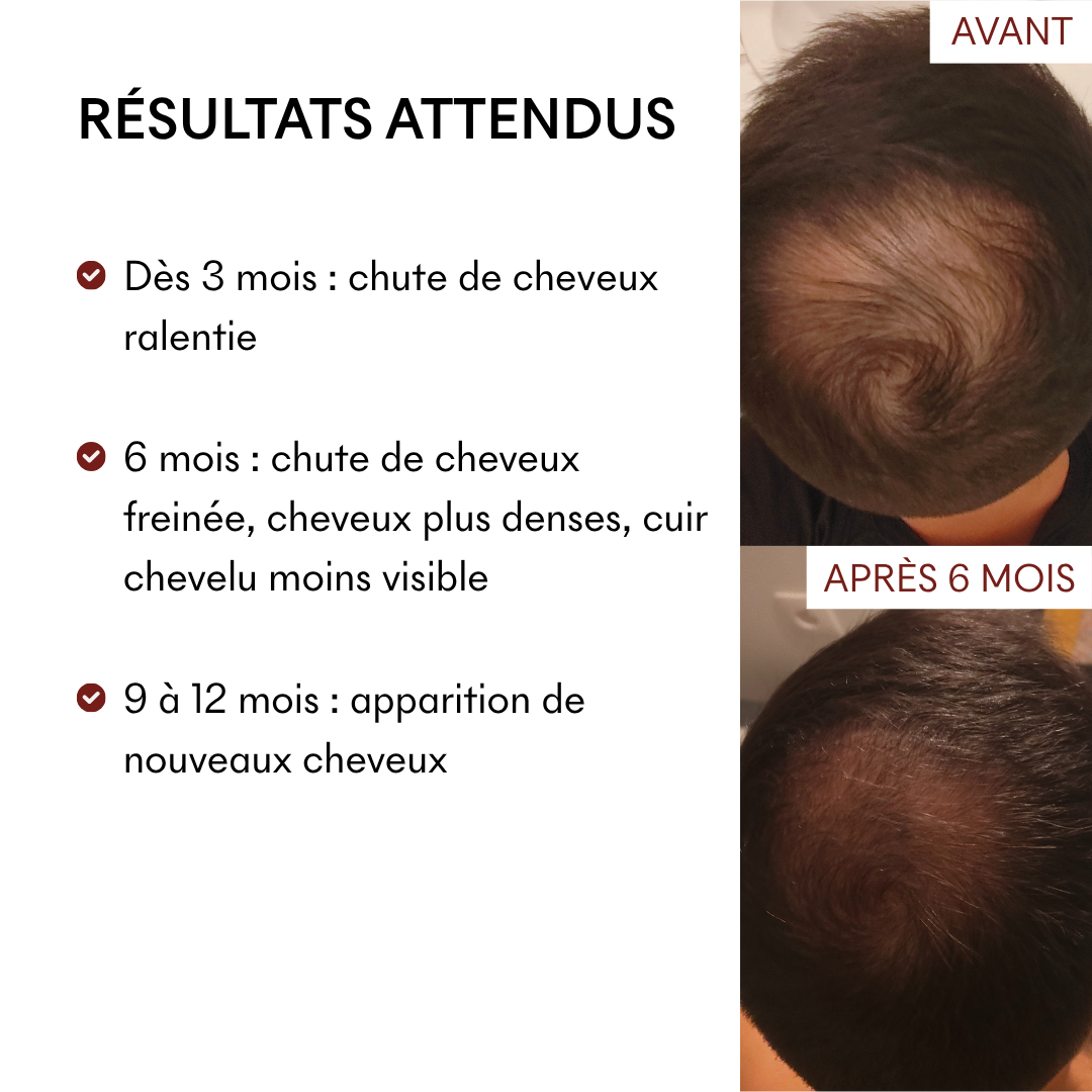 Offre 3+1 DHT Blocker Anti-Chute Hormonale 3 MOIS